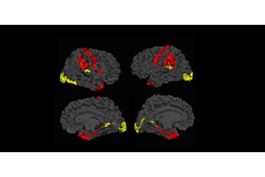 Bestudering MRI-scans geeft hoopvolle resultaten voor schizofrenie-patiënt