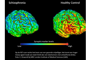 Onderzoek levert bewijs voor disfunctionele neuronen bij mensen met schizofrenie