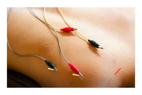 elektroacupunctuur