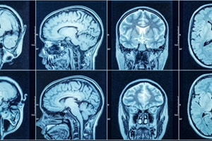 'Alzheimeronderzoek stagneert doordat amyloïdhypothese blijft domineren'